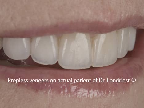 Empress Veneers Prep less Veneers | Empress Veneers