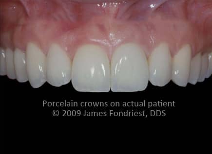 Procera crowns, aluminum oxide based crowns, aluminum oxide copings Procera crowns, aluminum oxide based crowns, aluminum oxide copings