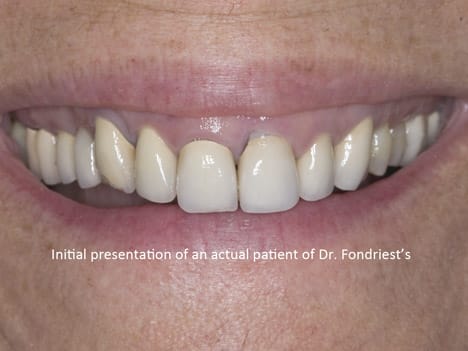 Patient with Gummy smile needs reconstructive dentistry Patient needing reconstructive dentistry, Gummy smile