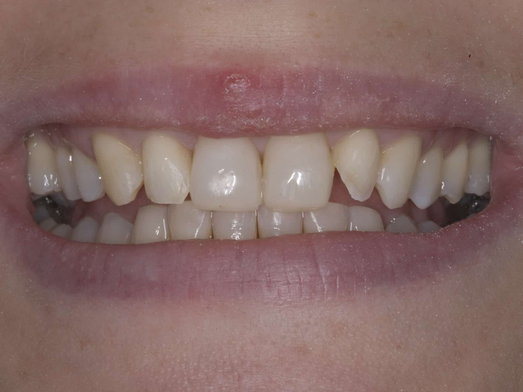 poorly done composite veneers poorly done composite veneers