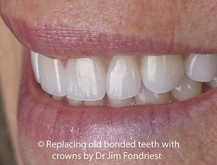 photo of Porcelain crowns and veneers Replace Old Bonding