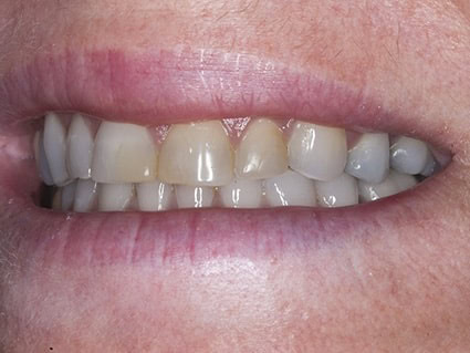 Image of stained and discolored bonding Image of stained and discolored bonding
