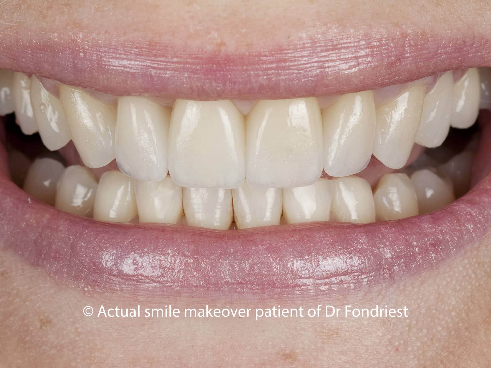E Max porcelain veneers, Veneers as alternative to orthodontics Ultra thin veneers