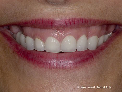 Crown lengthening for a gummy smile Crown lengthening for a gummy smile