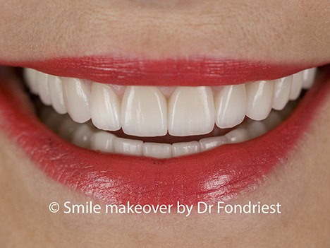 Raising the gumline to fix a gummy smile Raising the gum line to fix a gummy smile