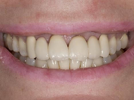 opaque porcelain bridgework, correction of angled teeth, unnatural dentistry bridges all porcelain bridge before