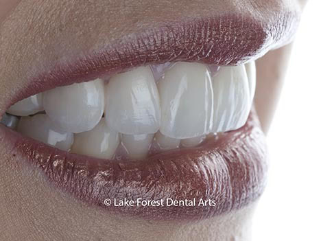 Esthetic PFM fixed dental bridges, dental bridge before and after PFM fixed dental bridges, dental bridge before and after