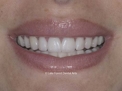 Porcelain veneers used to lengthen teeth Bruxism veneers for worn teeth