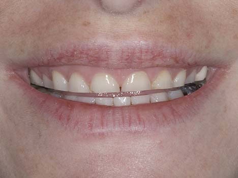 Shortened teeth from nighttime bruxism, tooth grinding Replacing lost tooth enamel with bruxism veneers