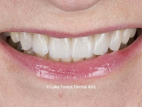 Image of E Max porcelain crowns Tooth caps before and after