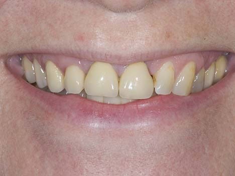 ugly crowns straighten teeth without braces