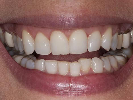 Crowns with black lines and occlusal plane cant / slant Crowns with black lines and occlusal plane cant / slant