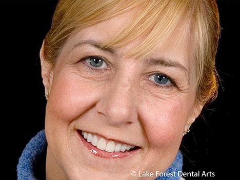 Correcting the length, shape and brightness of teeth Correct tooth shapes with veneers