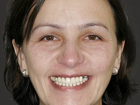Opaque dental bridge, Northbrook, Ilinois resident Opaque dental bridge, Northbrook, Ilinois resident