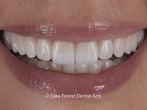 Minimal prep veneers Minimal prep veneers
