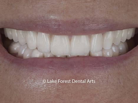 Example of 'prosthodontic makeover after image of prosthodontic makeover