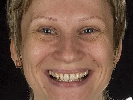 small lower jaw, supererupted teeth, alternative to orthodontics small lower jaw, supererupted teeth, alternative to orthodontics