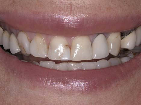 A Patient needing a Smile Makeove Smile makeover before image