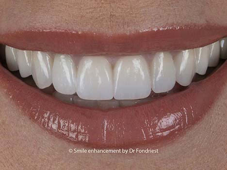 Smile Makeover Example of Cosmetic Prosthodontic Treatment