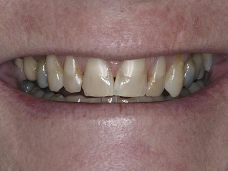 Uneven smile, ugly porclein crowns, black lines Uneven smile, ugly porclein crowns, black lines