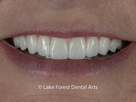 Are veneers better than crowns - after image Are veneers better than crowns - after image
