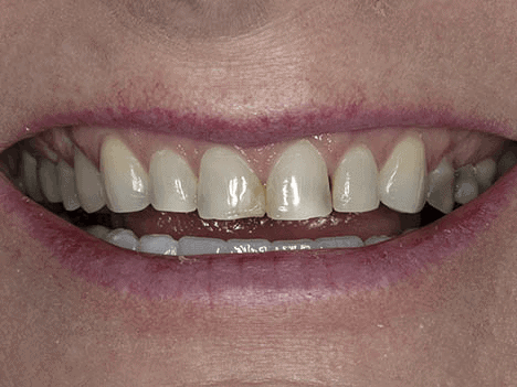 before treatment image of patient deciding to do veneers over crowns Are veneers better than crowns - before image