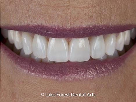 Opalescence in porcelain veneers Opalescent Porcelain Veneers