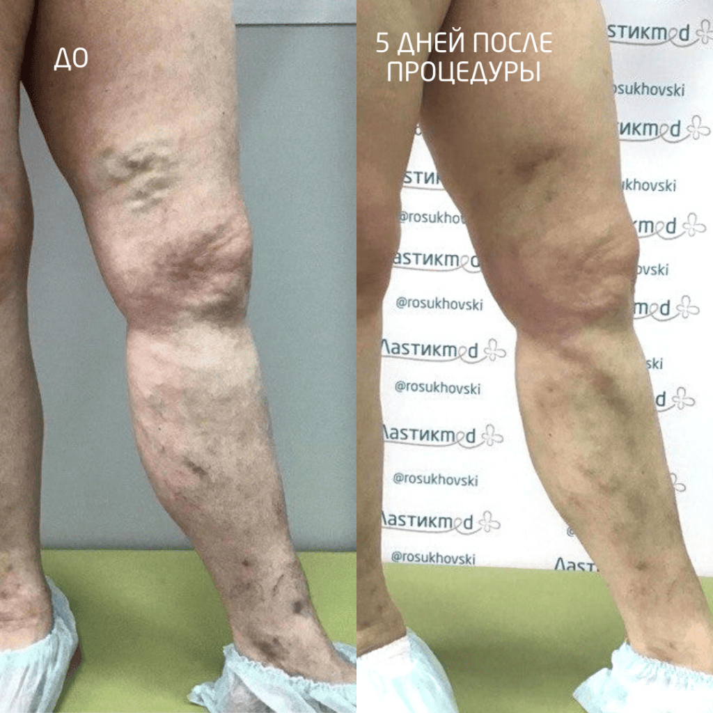 ЭВЛК нижних конечностей фото до и после