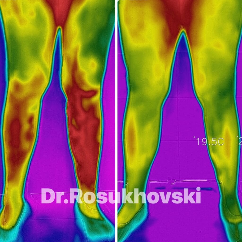 лечение варикоза в спб ЭВЛК