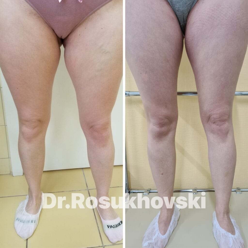 лечение варикоза цена ЭВЛК