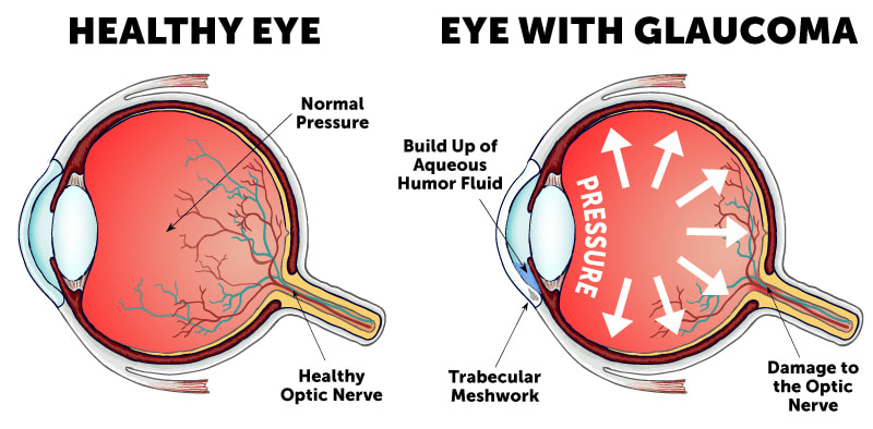Glaucoma
