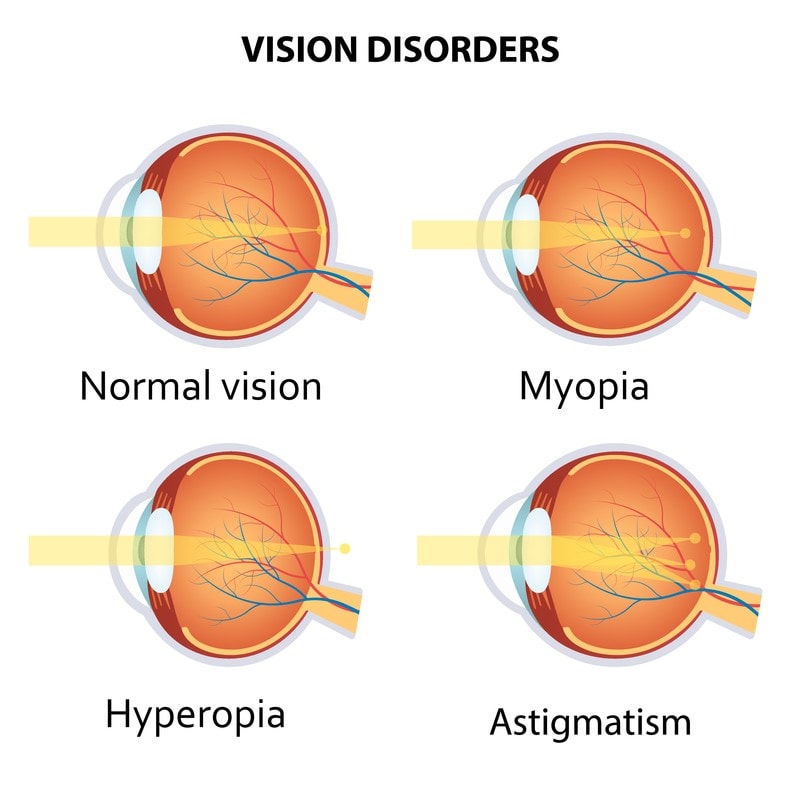 Types of refractive errors
