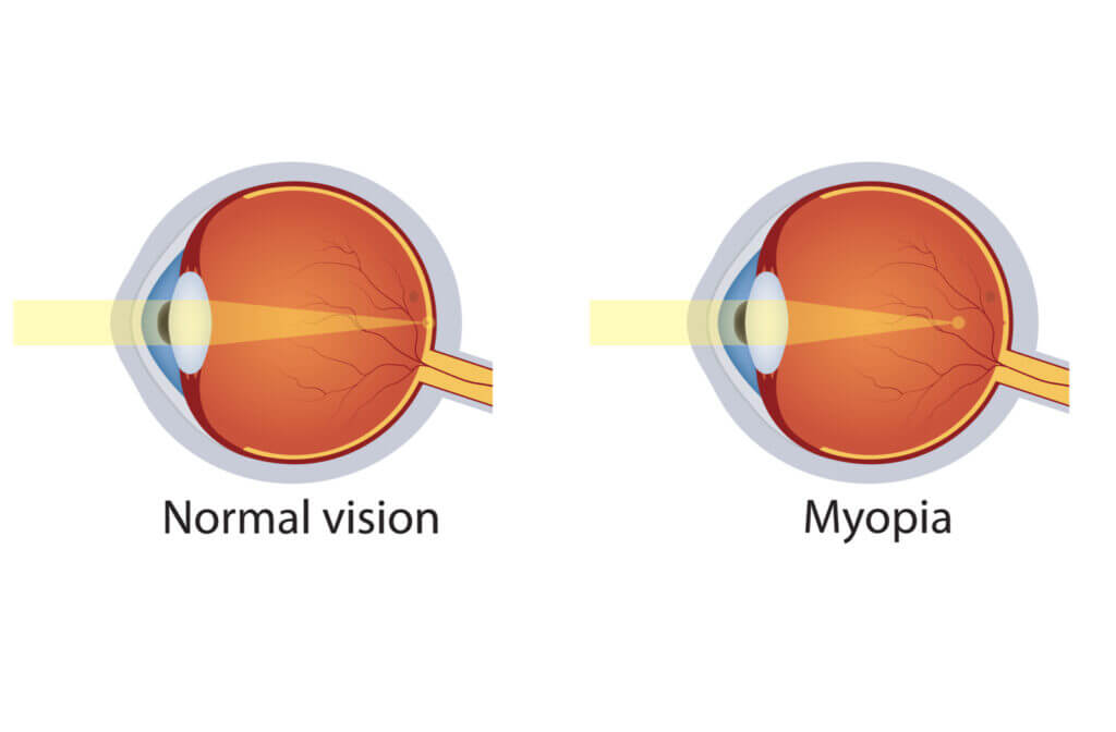 Myopia Vision