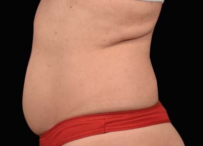 Emsculpt neo despues