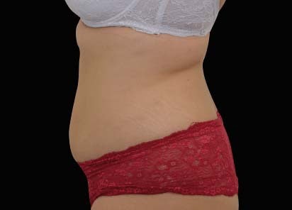 Emsculpt neo mallorca