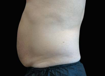 emsculpt neo antes y despues