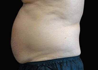 emsculpt neo tratamiento