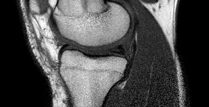 Synovial joint