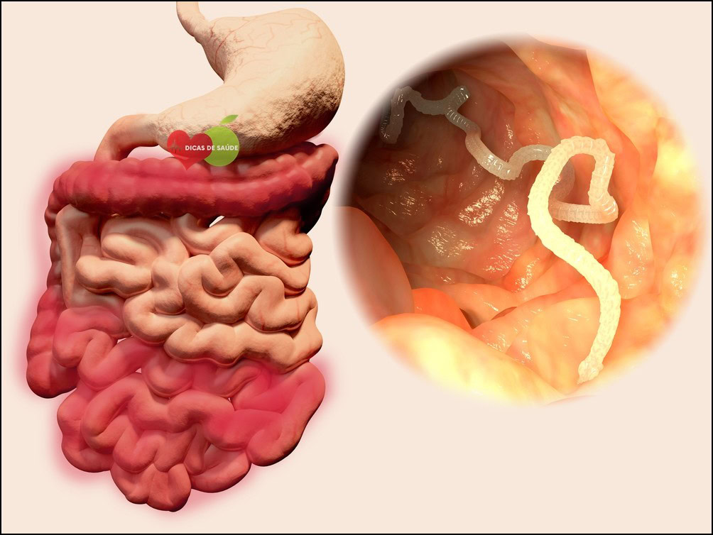 Como Eliminar Vermes Intestinais