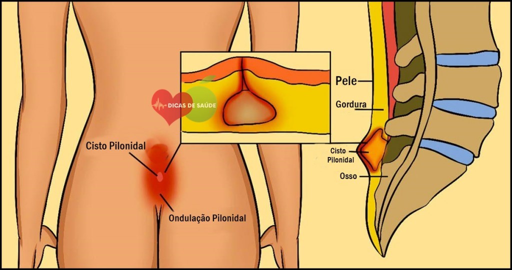 Cisto Pilonidal
