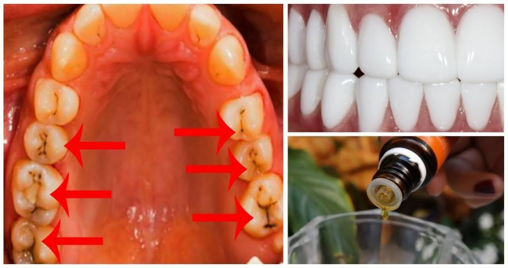 oleo de coco e curcuma para tratar problemas dentarios