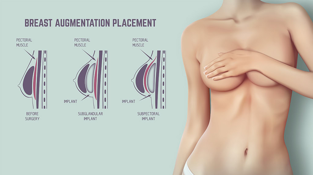 Breast Augmentation Placement