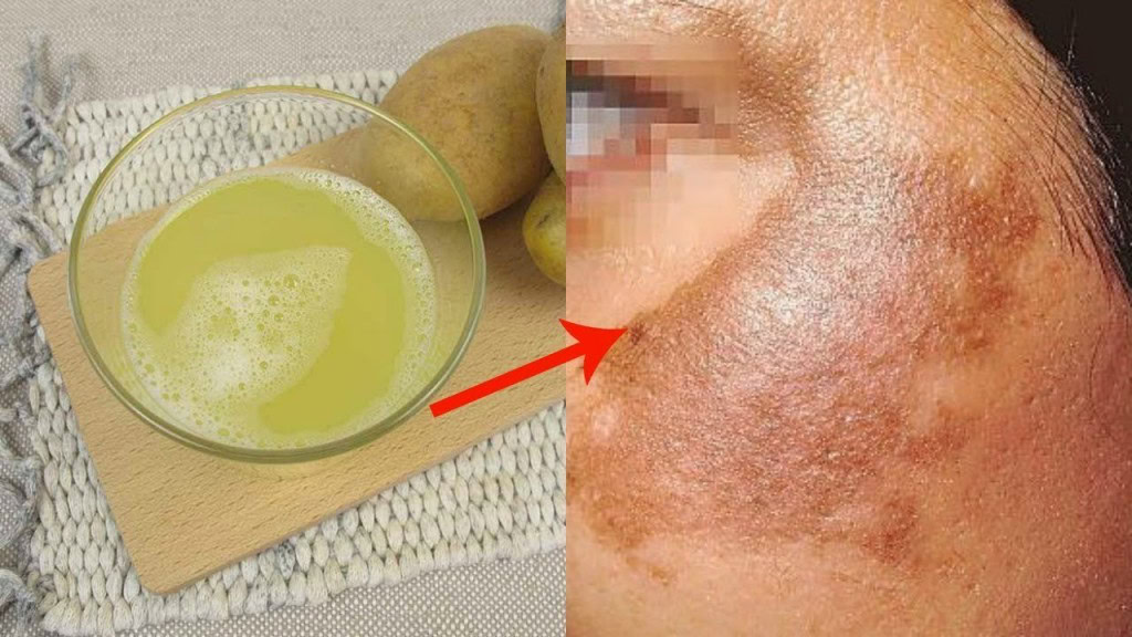 Máscara Para Remover Manchas, Cicatrizes, Acne e Rugas