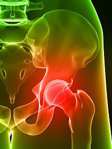 Image of an inflamed hip joint