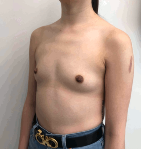 BBA3 Before Breast Implants Photo #3