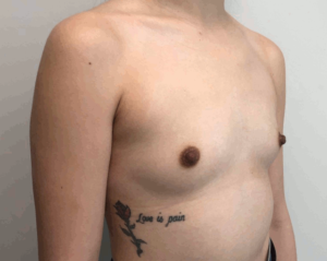 BBA3 Before Breast Implants Photo #1