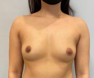 BBA1 Before Breast Augmentation Photo #2