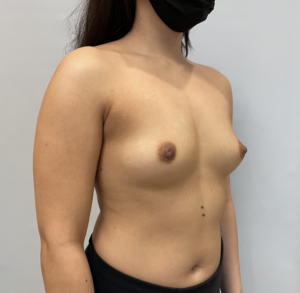BBA1 (Before Breast Augmentation Photo #1)