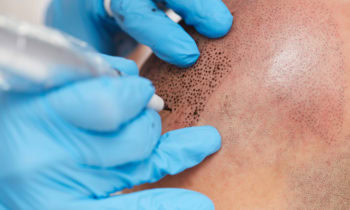 Kopfhaut-pigmentierung