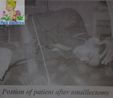 Tonsillectomy